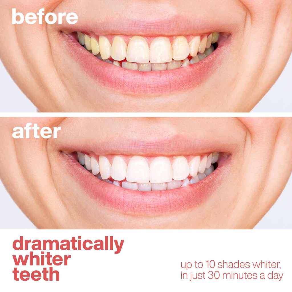 Professional Teeth Whitening Strips