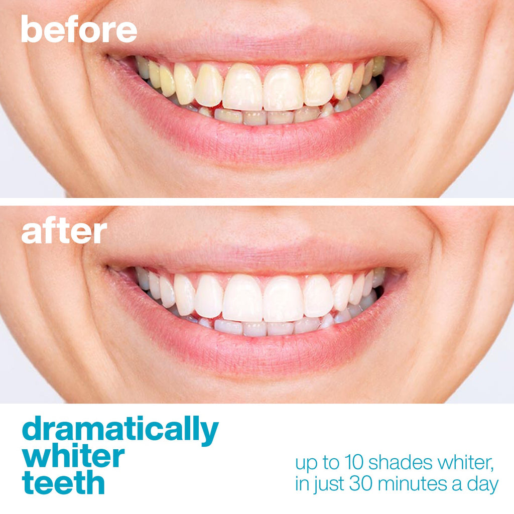 Professional Teeth Whitening Strips